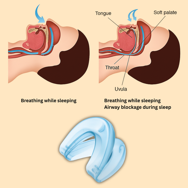 SnoreLess™ Anti Snoring Mouthpiece